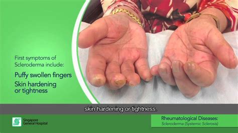 Systemic Scleroderma Hands