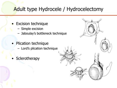 PPT - Surgical Treatment of Hydrocele & Hernia PowerPoint Presentation ...