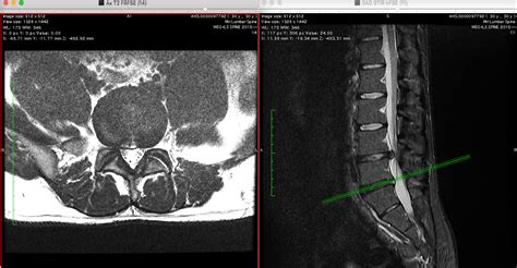 Finally got my MRI report. : Sciatica