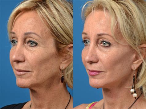 Facelift Photos | Melbourne, FL | Patient 52551