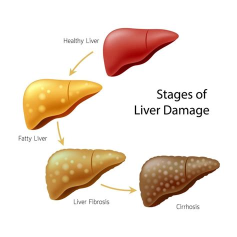 10 Signs of Liver Damage - Facty Health