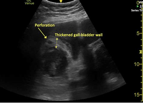 Case 32: Perforated Gallbladder - UCSD Ultrasound