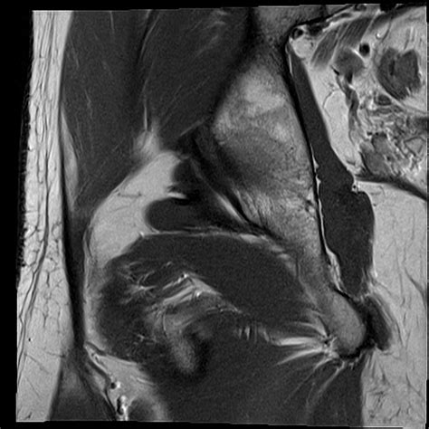 normal hip MRI coronal 6 Diagram | Quizlet