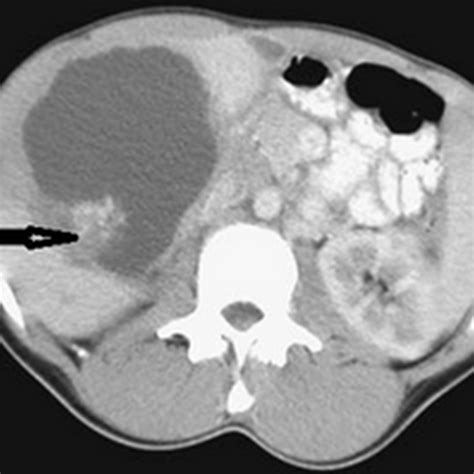 Hydatid cyst - Radiology Imaging