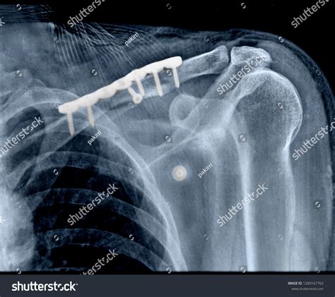 Radiography Clavicle Fracture Stock Photo 1289167762 | Shutterstock