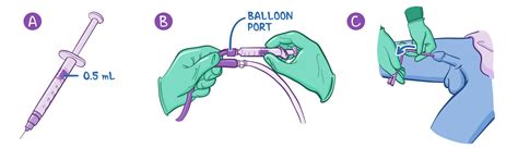 Removing indwelling catheters: Clinical skills notes | Osmosis