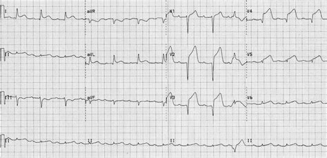 The St Segment Litfl Medical Blog Ecg Library Basics 53352 | The Best ...