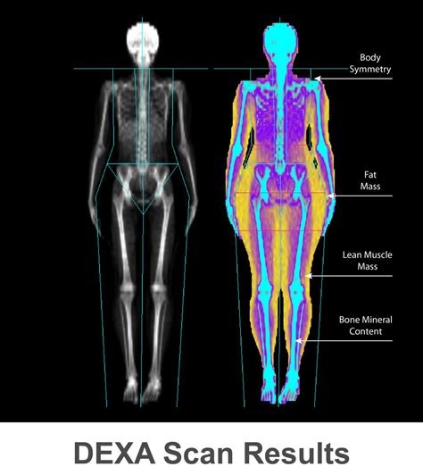 DEXA (DXA) Scan: Bone Density Test - Accurate Imaging Diagnostics