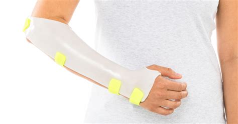 The Muenster Orthosis and Sugar Tong Orthosis - Orfit Industries