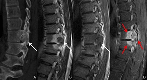 Osteoblastoma of the thoracic spine presenting with back pain - The ...