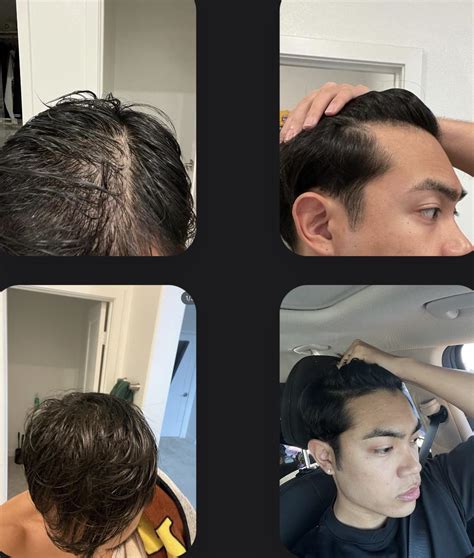 Before and after with minoxidil +fin : r/minoxidil