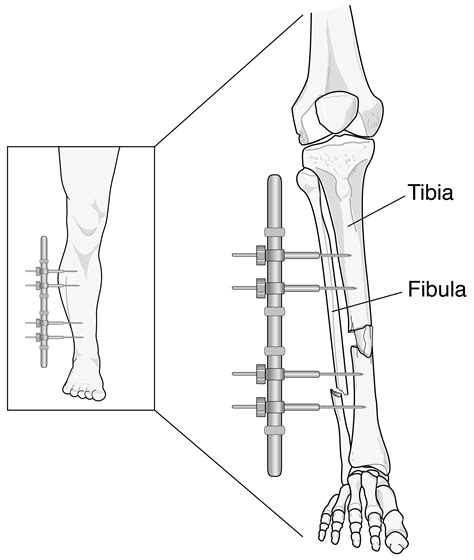 External Fixation