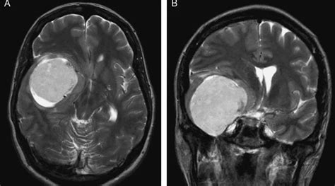 Meningioma What It Is Causes Symptoms Treatment - ZOHAL