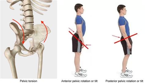 How to Fix Rotated Pelvis With Clinical Somatics Exercises