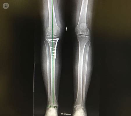 Knee osteotomy vs. knee replacement surgery