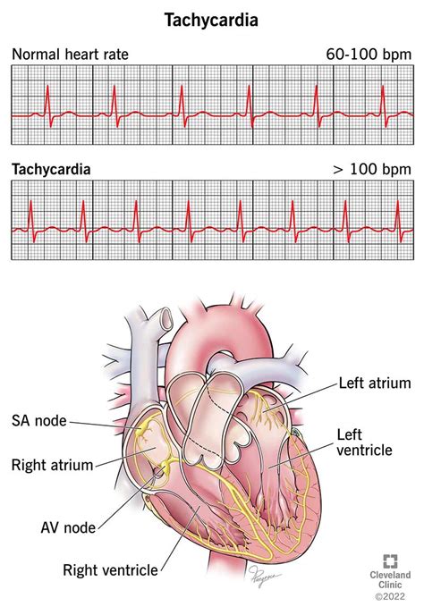 Tachycardia: Symptoms, Causes & Treatment