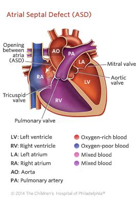 Atrial Septal Defect | Children's Hospital of Philadelphia