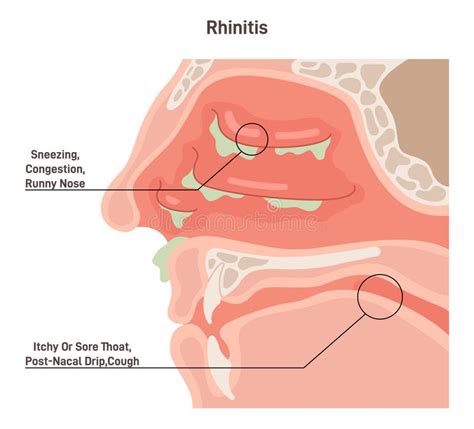 Rhinitis. Irritation and Inflammation of the Mucous Membrane of Nasal ...