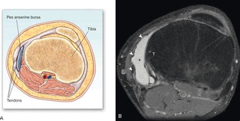 Pes Anserine Bursitis | Anesthesia Key