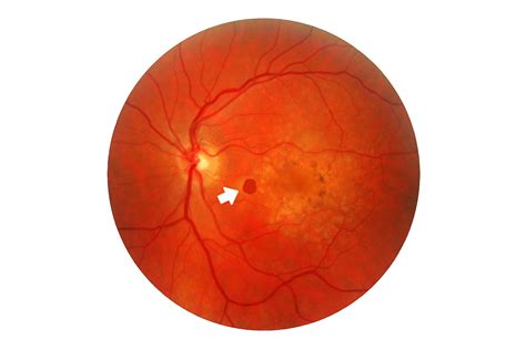 Lifestyle Changes for the Treatment of Macular Degeneration - Nashville, TN