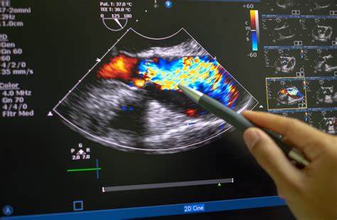 Echocardiography (ultrasound). - Parker University