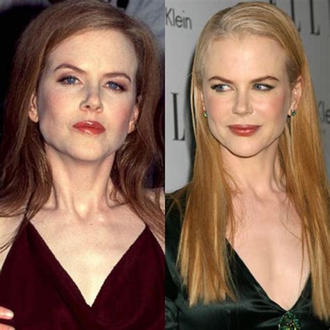 Nicole Kidman Before And After Plastic Surgery Pictures