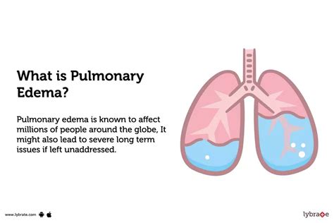 Pulmonary Edema - Symptom, Causes, Treatment And Prevention