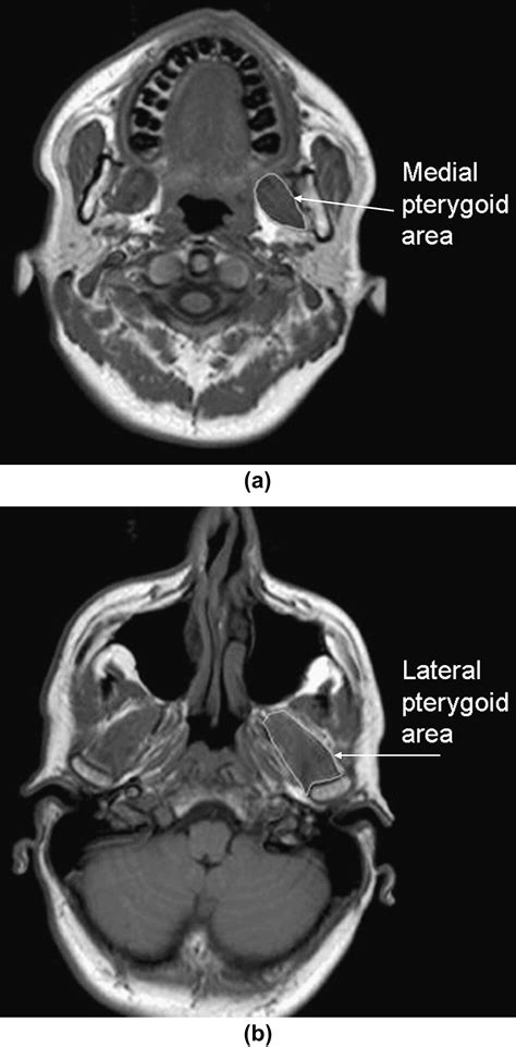 Magnetic resonance imaging of facial muscles - Clinical Radiology