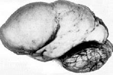 Lissencephaly of the brain: causes, symptoms, treatment