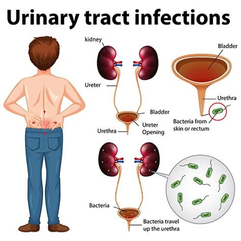 Xét nghiệm cấy nước tiểu tìm vi khuẩn gây nhiễm khuẩn đường tiết niệu ...