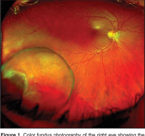 Figure 1 from Idiopathic giant retinal cyst. | Semantic Scholar