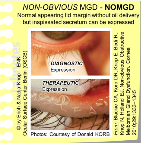 Meibomian Gland Dysfunction (MGD) — Ocular Surface Center Berlin