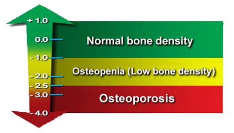 Bone Density Chart | T Score Chart - How to Understand