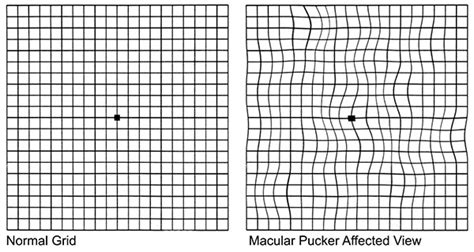 Macular Pucker Treatment - Best Retina Doctors in New York