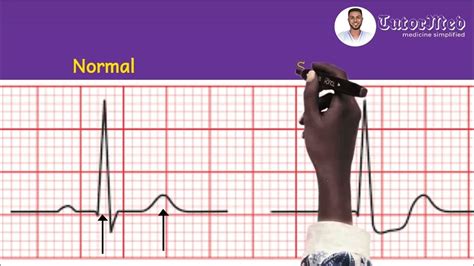 ECG changes of Unstable Angina & NSTEMI - TutorMed #electrocardiogram # ...