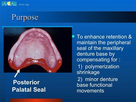 26.posterior palatal seal