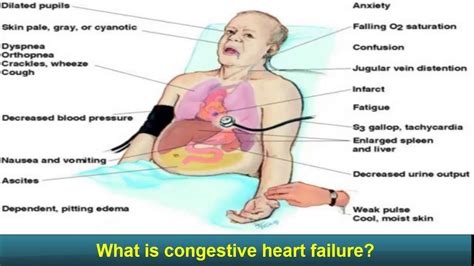 Congestive Heart Failure - congestive heart failure - Explained - MADE ...