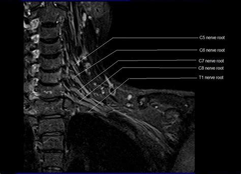 Brachial Plexus Axial MRI