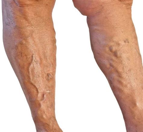 Vein Types | Dermatology, Laser & Vein Specialists of the Carolinas