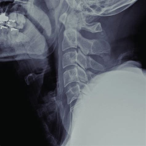 (PDF) Mandibular Fracture Masking Hyoid Bone Fracture