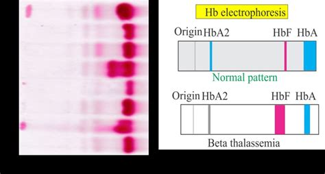 Hemoglobin:- Part Hemoglobin Electrophoresis, (Hb, 56% OFF