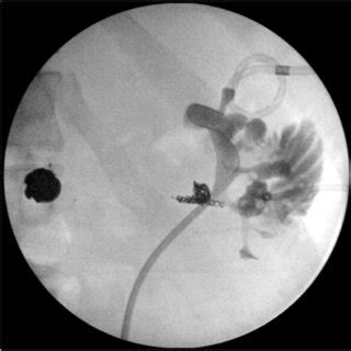 Left Retrograde Pyelogram with Fistula Left retrograde pyelogram ...