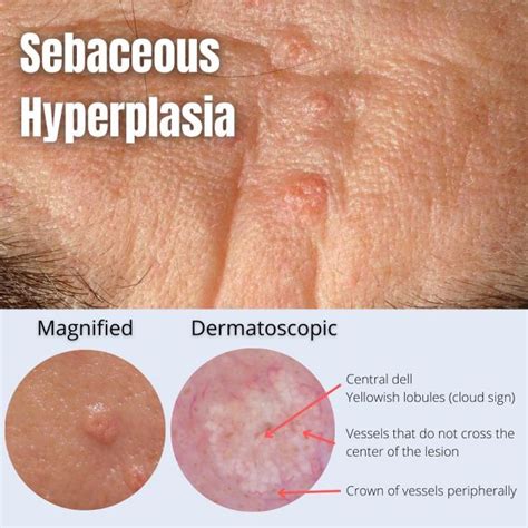 Understanding Sebaceous Hyperplasia: Causes And Treatment, 53% OFF