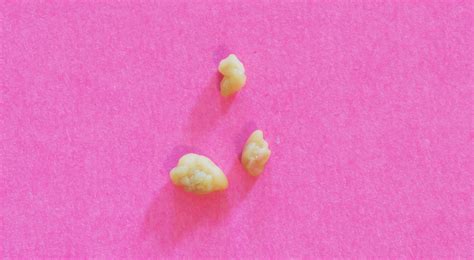 Tonsil Stones: Symptoms, Causes, and How to Remove | Dental Jay