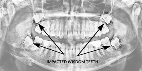 Wisdom Teeth | Oral Surgery Procedures