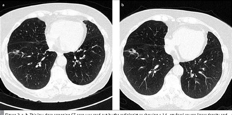 [PDF] Screening for lung cancer with low-dose CT scans. | Semantic Scholar