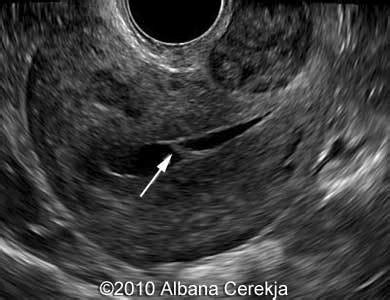 📃 Uterine synechiae