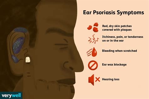 Ear Psoriasis: Symptoms, Causes, Diagnosis, and Treatment