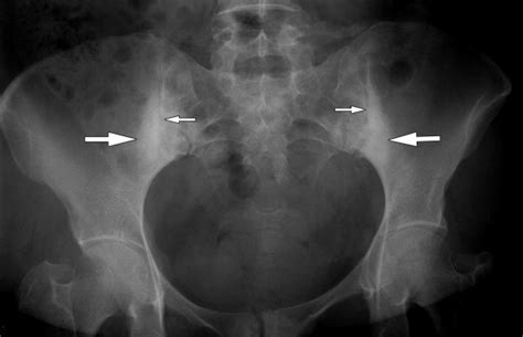 Sacroiliitis | Radiology Key