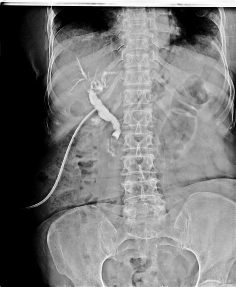 Choledocolithiasis | Image | Radiopaedia.org